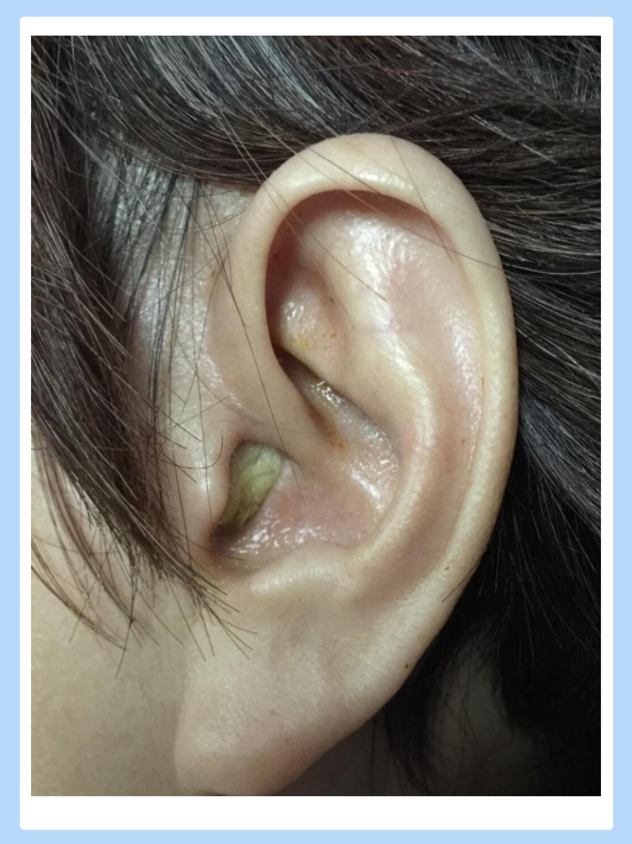 婴儿中耳炎症状图片(婴儿中耳炎症状的表现) 婴儿中耳炎症状图片(婴儿中耳炎症状的表现)
