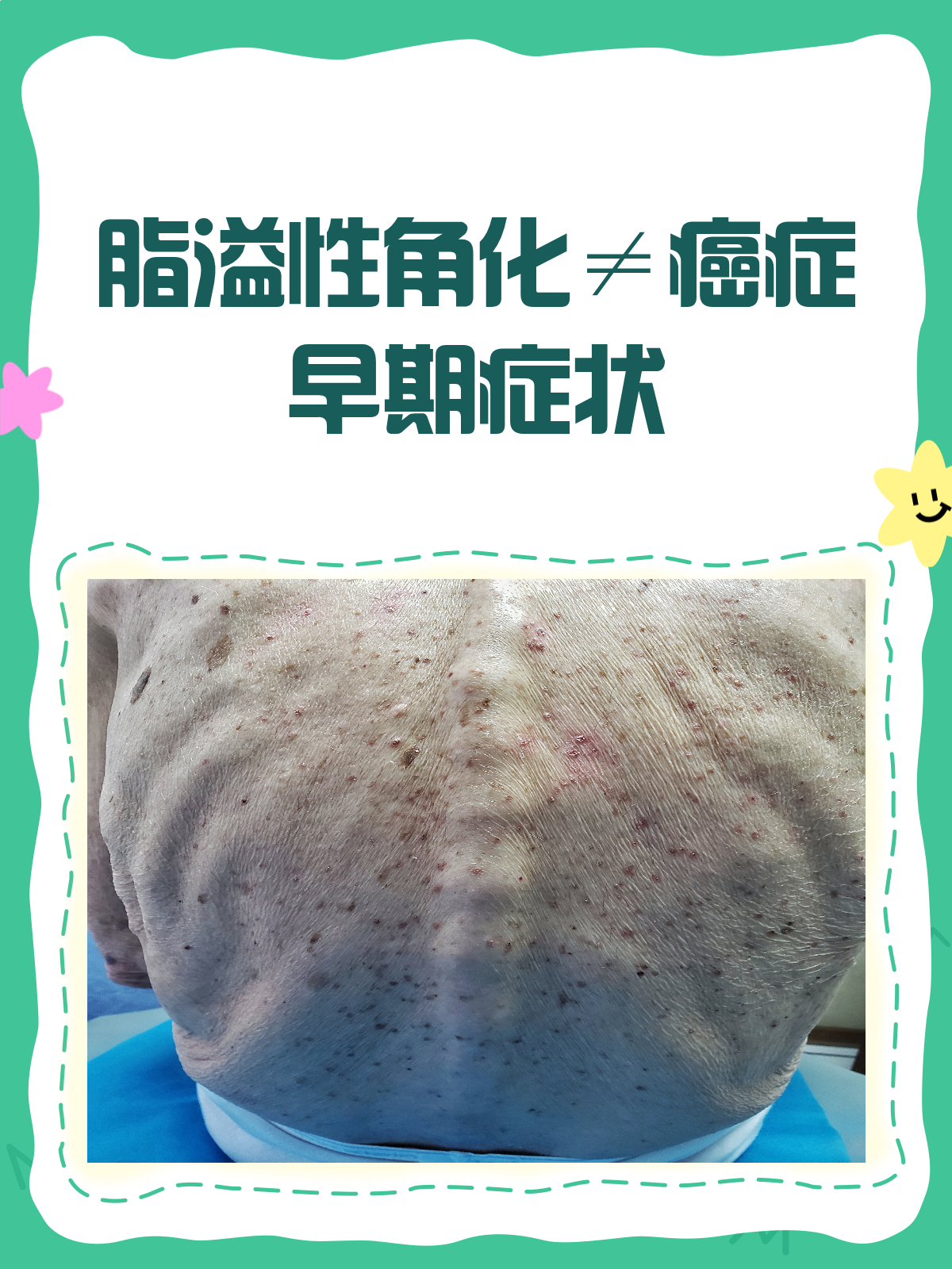 脂溢性角化病图片(脂溢性角化病图片 斑块)