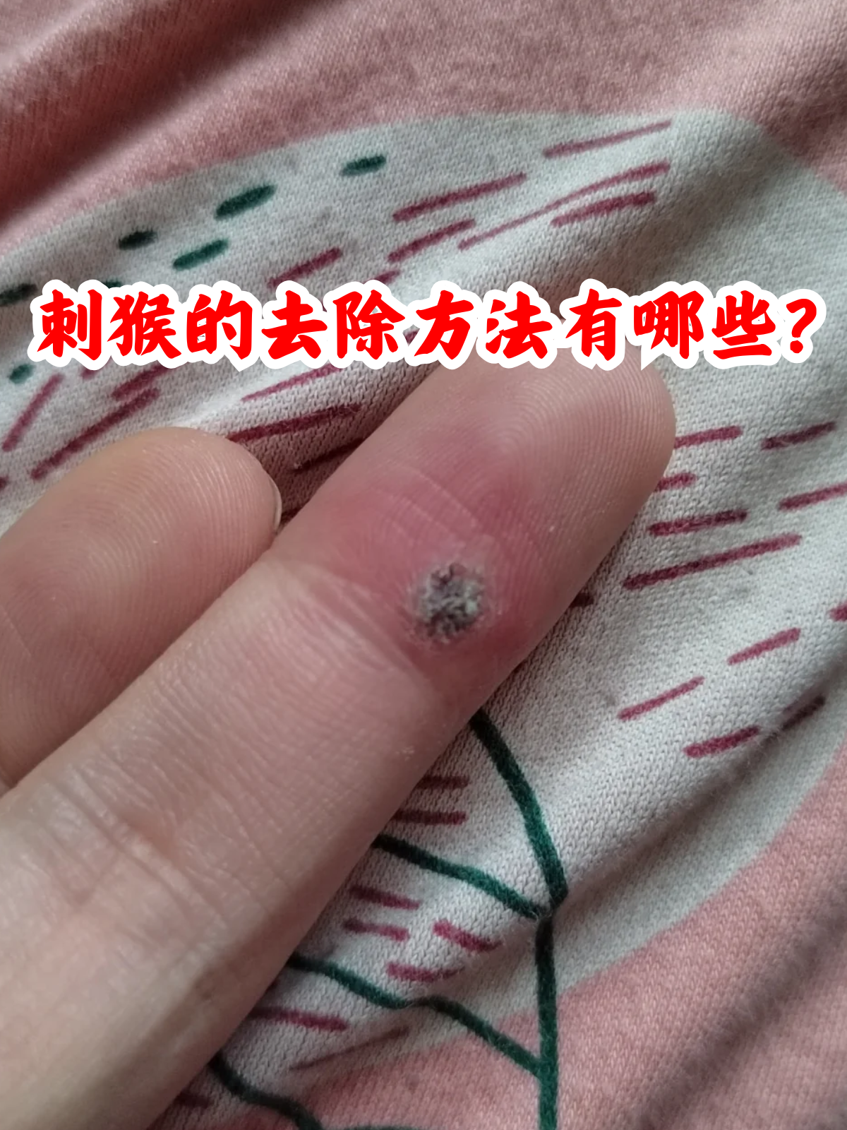 手部疣图片(手部疣是什么原因造成的)