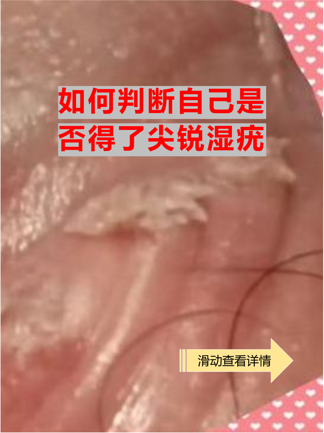 女性尖湿锐尤前期图(女性尖湿锐尤有哪些症状)