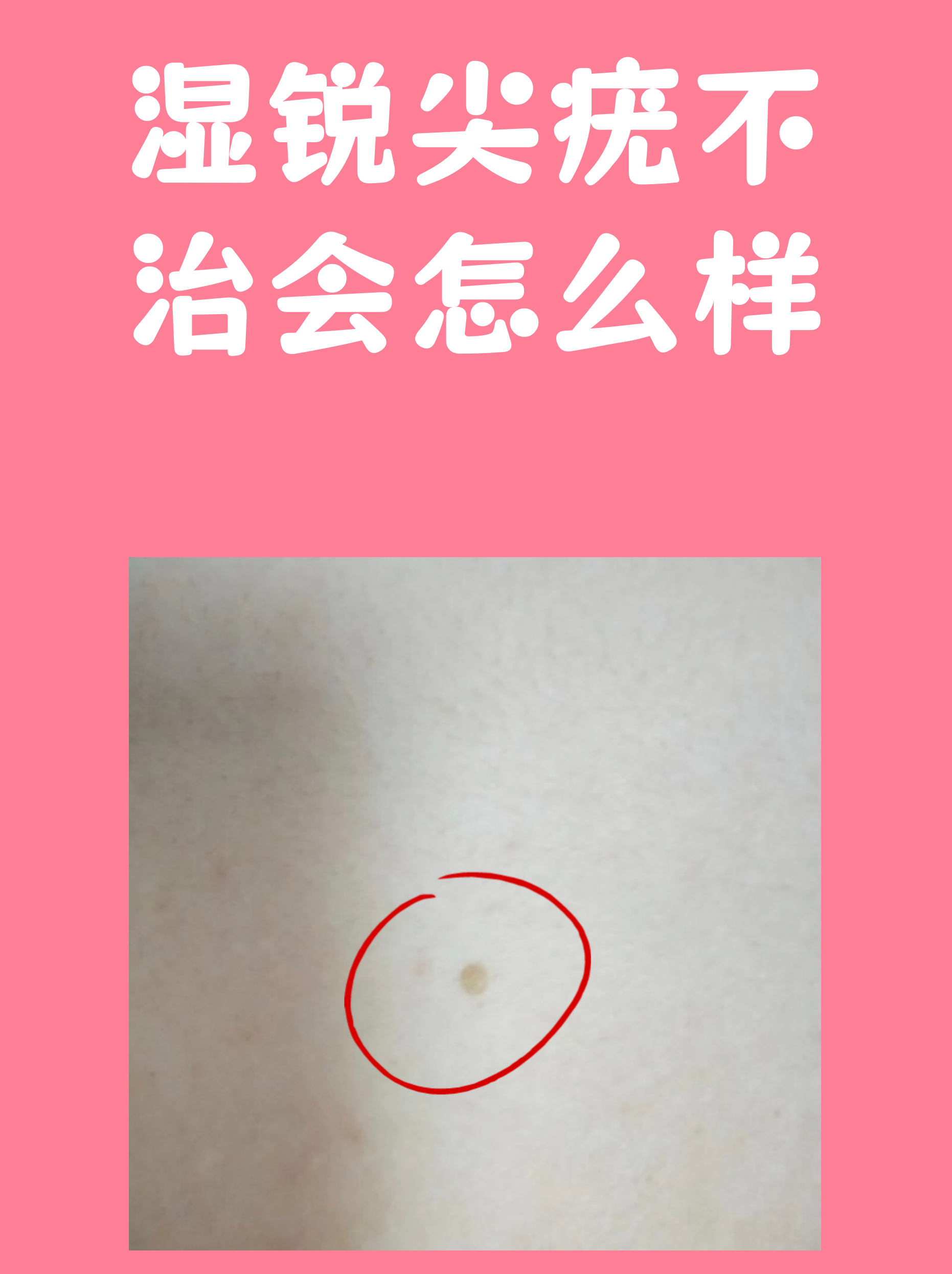 女性尖湿锐尤前期图(女性尖湿锐尤有哪些症状) 女性尖湿锐尤前期图(女性尖湿锐尤有哪些症状)