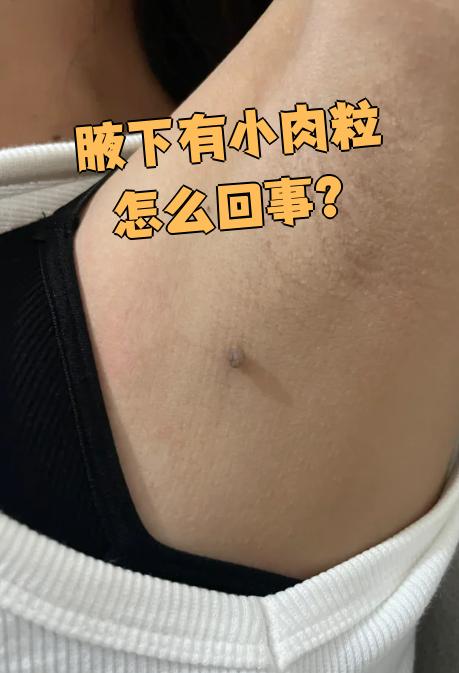 肉赘图片(大腿内侧肉赘图片)