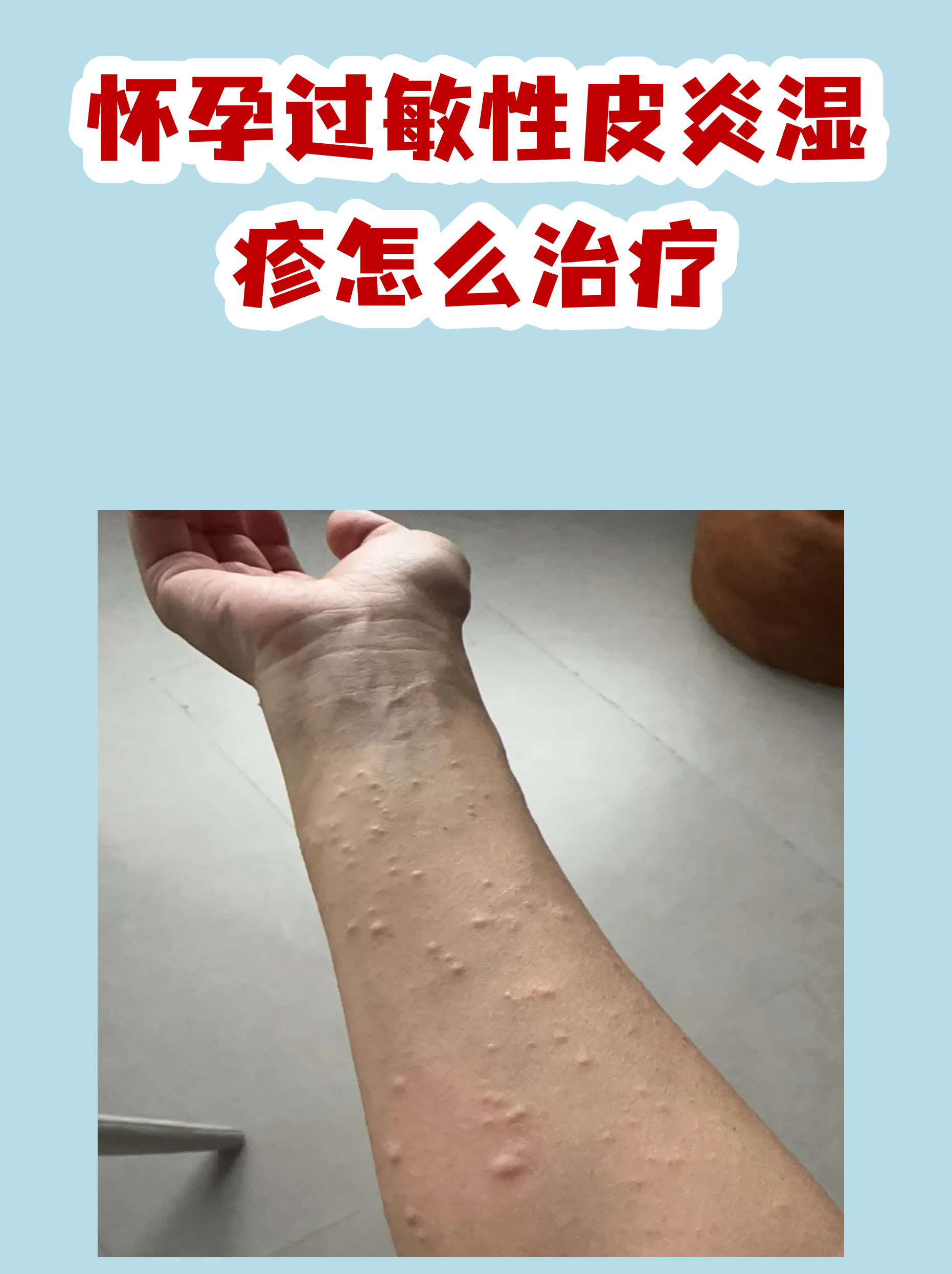 皮炎性湿疹的图片(皮炎性湿疹的治疗方法)