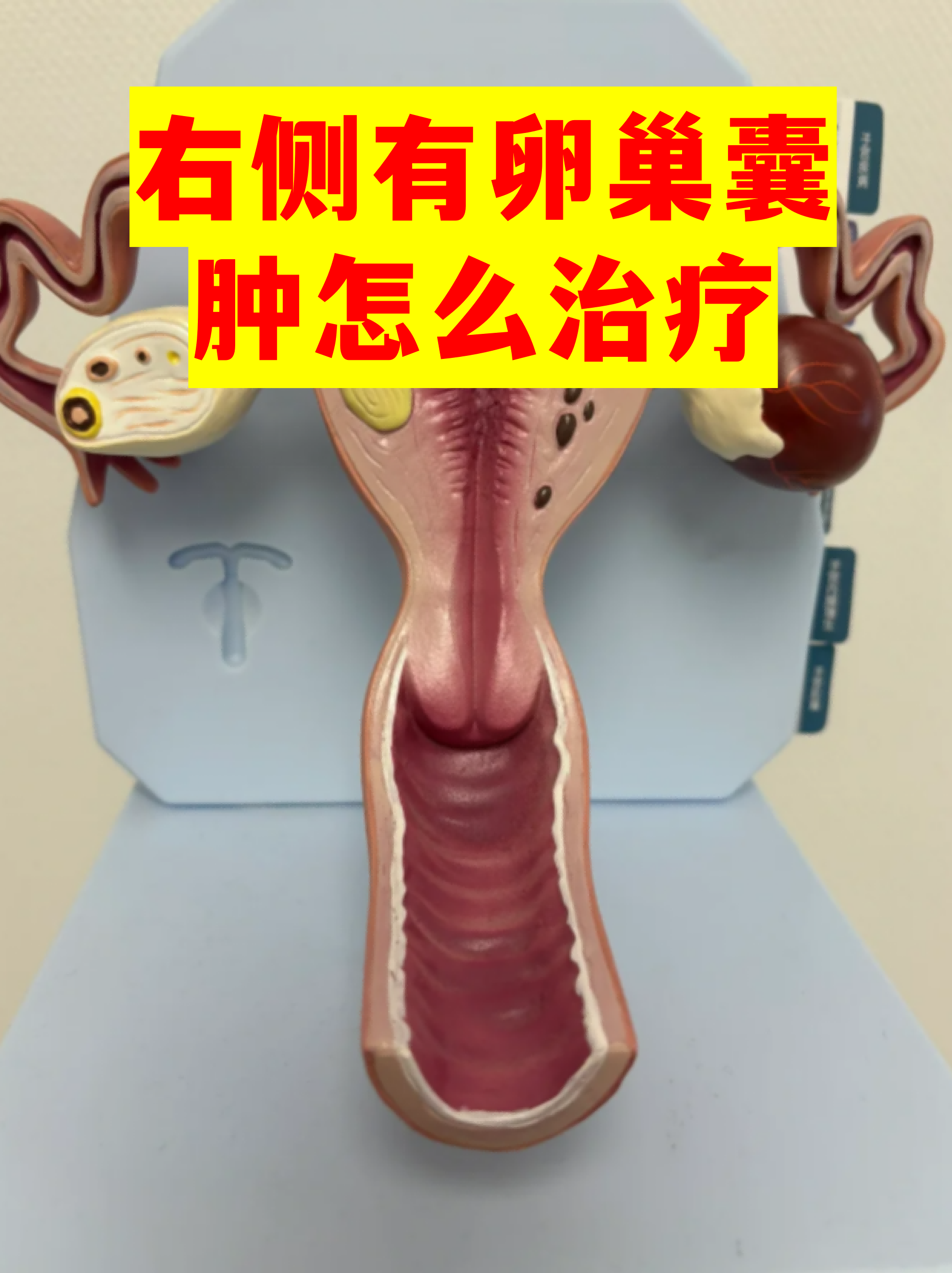 卵巢囊肿的图片(真人卵巢囊肿的图片)