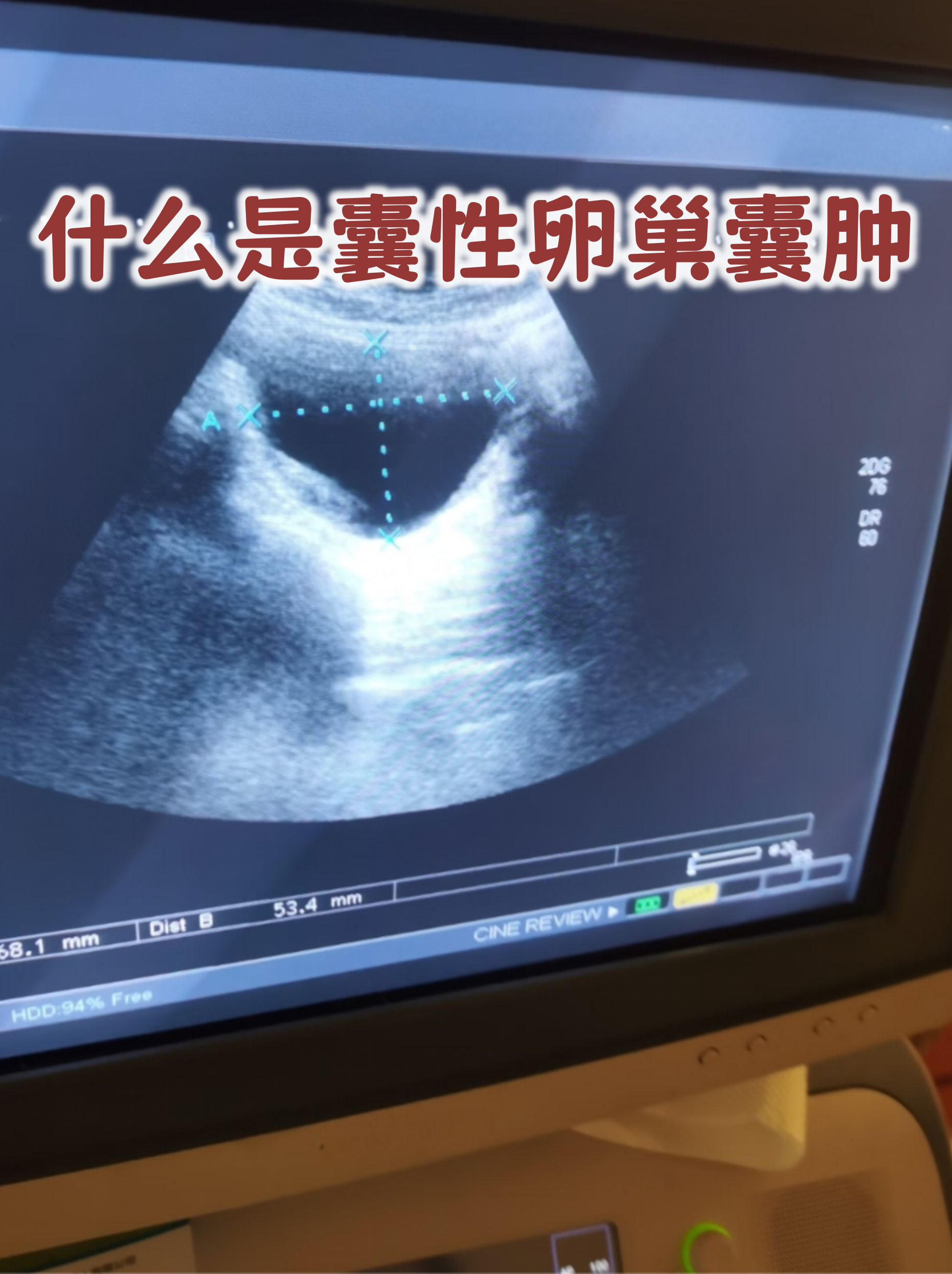 卵巢囊肿的图片(真人卵巢囊肿的图片)