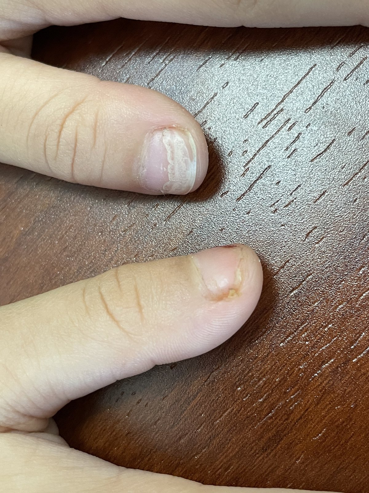指甲分层初期图片(指甲老分层是怎么回事)
