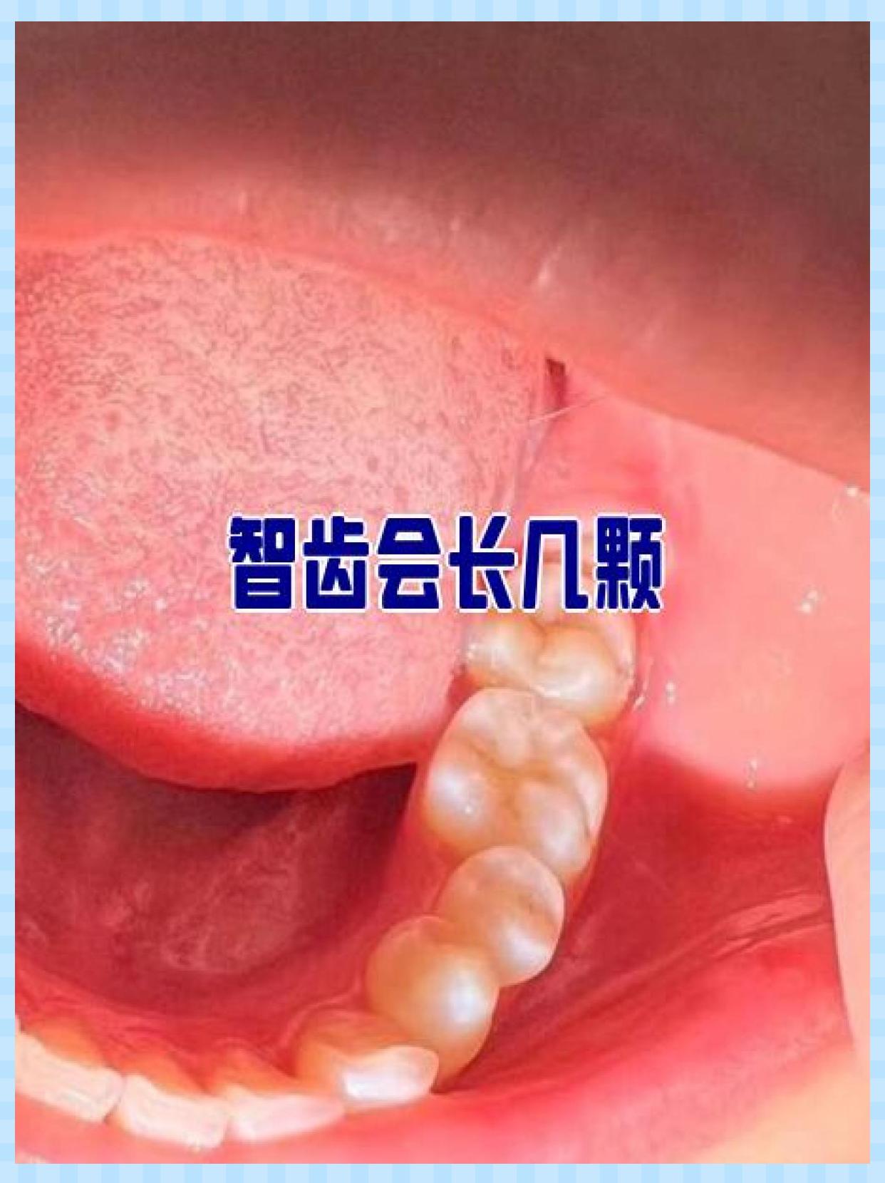 智齿的位置图片(智齿一定要拔掉吗)