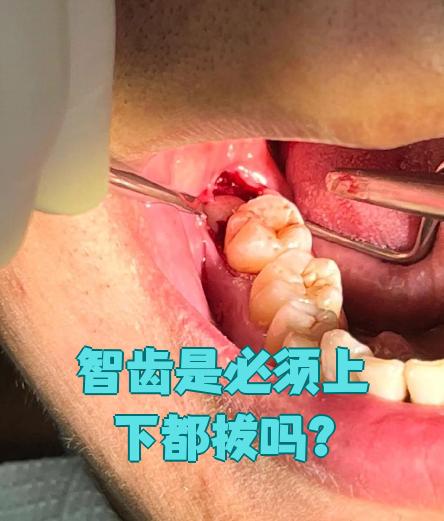智齿的位置图片(智齿一定要拔掉吗)