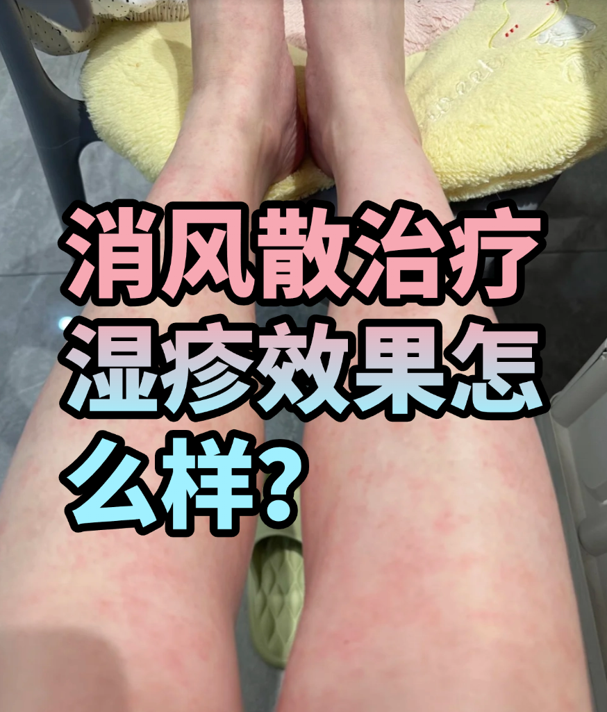 四物消风散(四物消风散方歌) 四物消风散(四物消风散方歌)