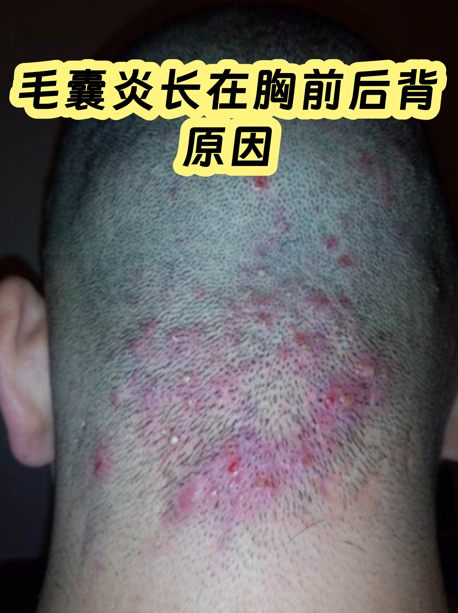 胸前毛囊炎真实图片(胸前毛囊炎疙瘩怎么消除)