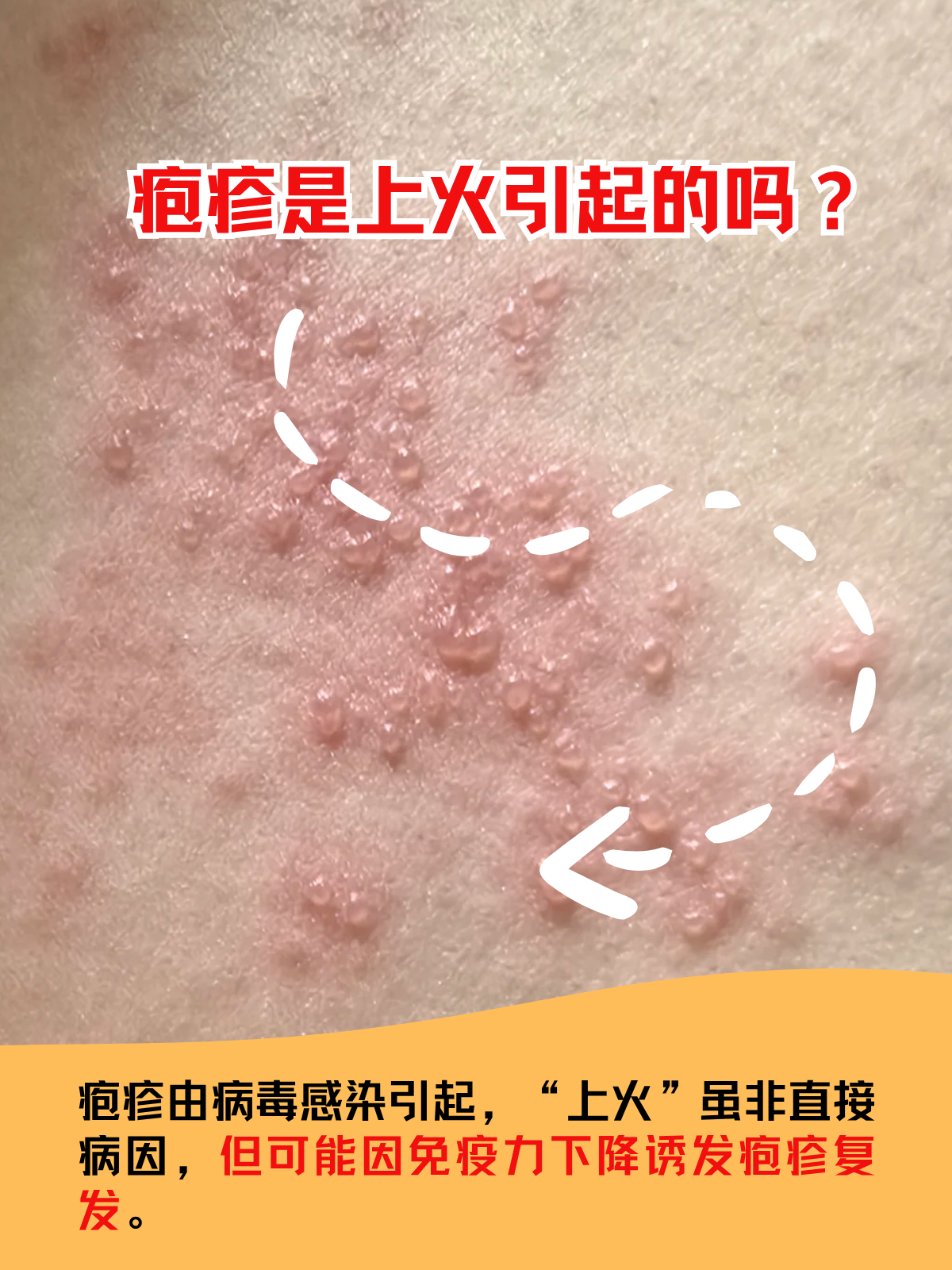 病毒性疱疹图片大全(病毒性疱疹图片大全大图) 病毒性疱疹图片大全(病毒性疱疹图片大全大图)