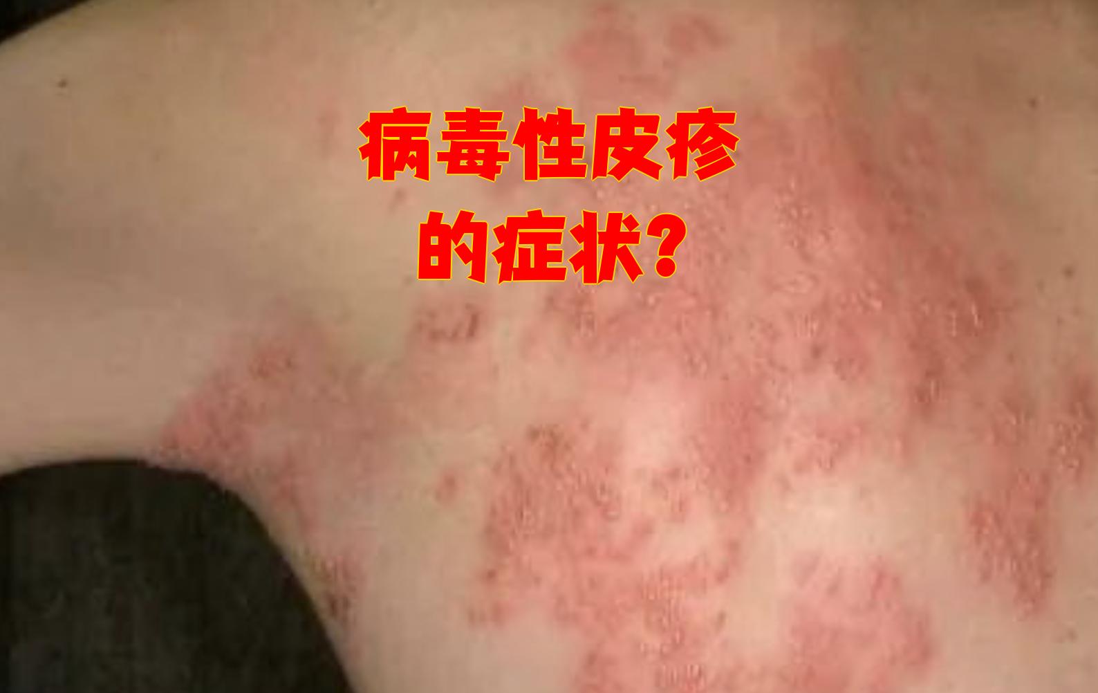 病毒性疱疹图片大全(病毒性疱疹图片大全大图) 病毒性疱疹图片大全(病毒性疱疹图片大全大图)