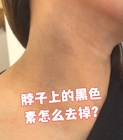 黑色素沉淀图片(胸前黑色素沉淀图片) 黑色素沉淀图片(胸前黑色素沉淀图片)