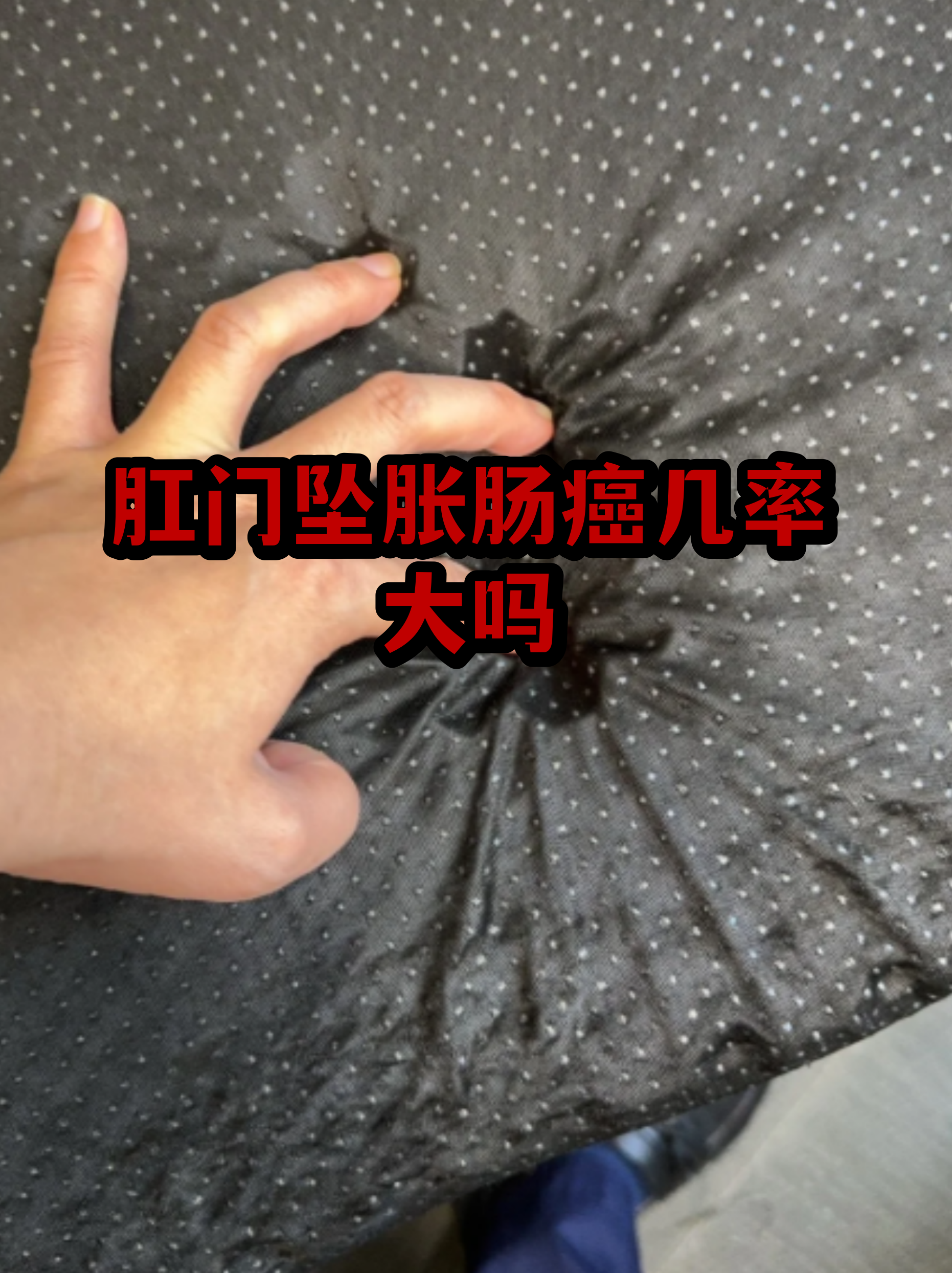 肛门图片(健康肛门和痔疮肛门图片) 肛门图片(健康肛门和痔疮肛门图片)
