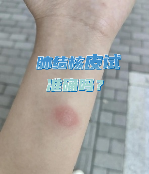 结核皮试结果正常图片(结核皮试正常图片是什么样的)