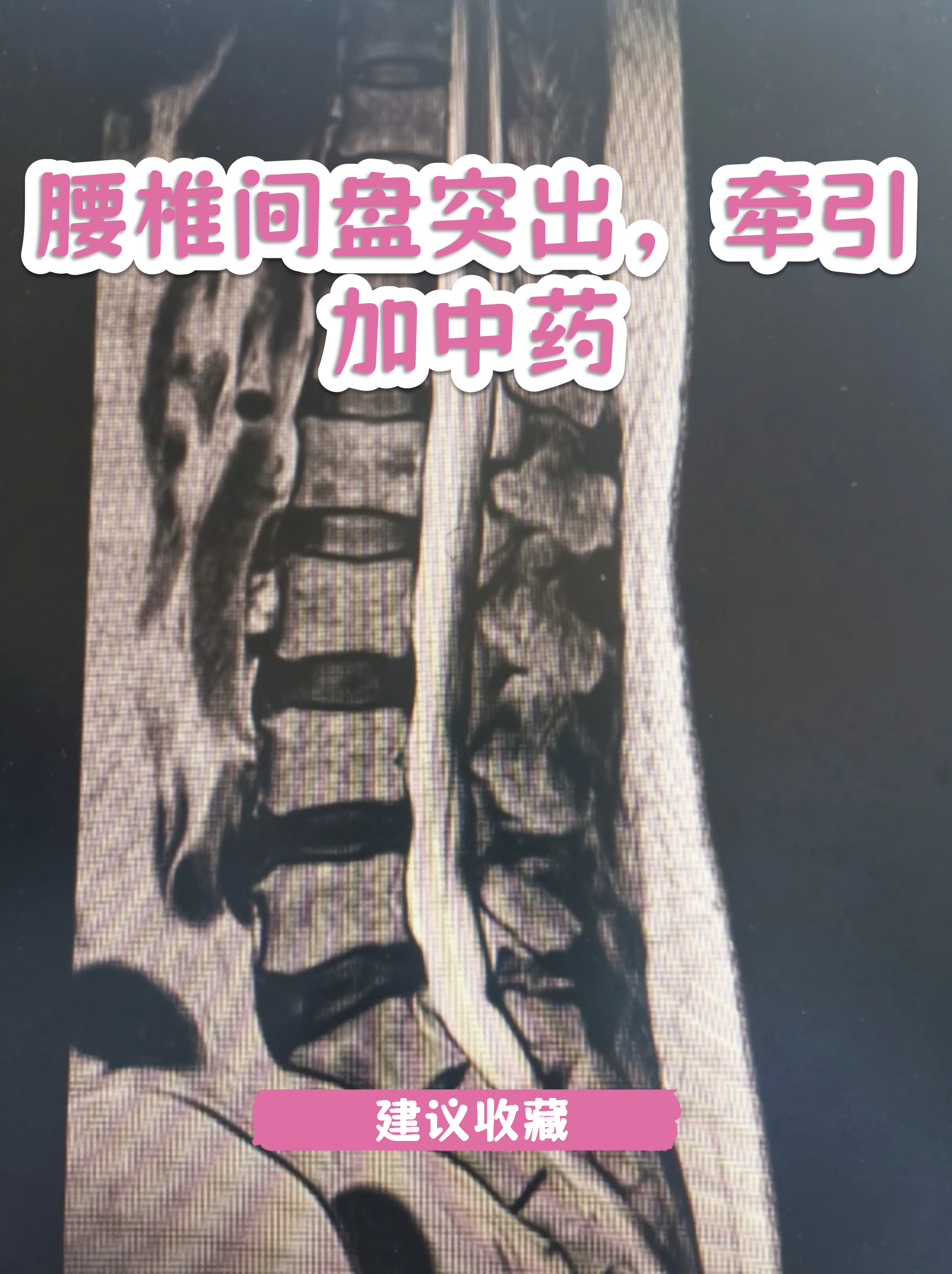 正常腰椎图片(正常腰椎图片跟腰椎盘突出图片) 正常腰椎图片(正常腰椎图片跟腰椎盘突出图片)