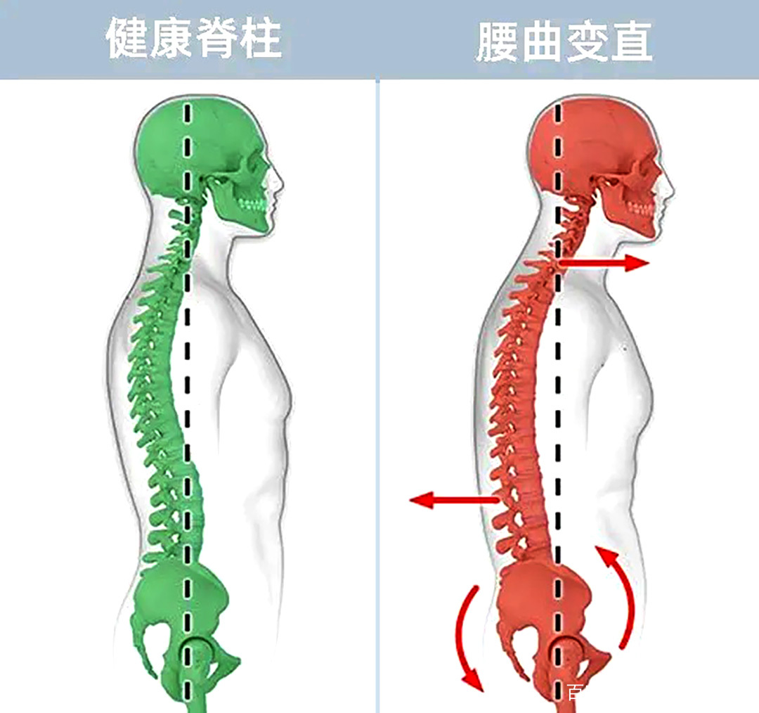 正常腰椎图片(正常腰椎图片跟腰椎盘突出图片) 正常腰椎图片(正常腰椎图片跟腰椎盘突出图片)