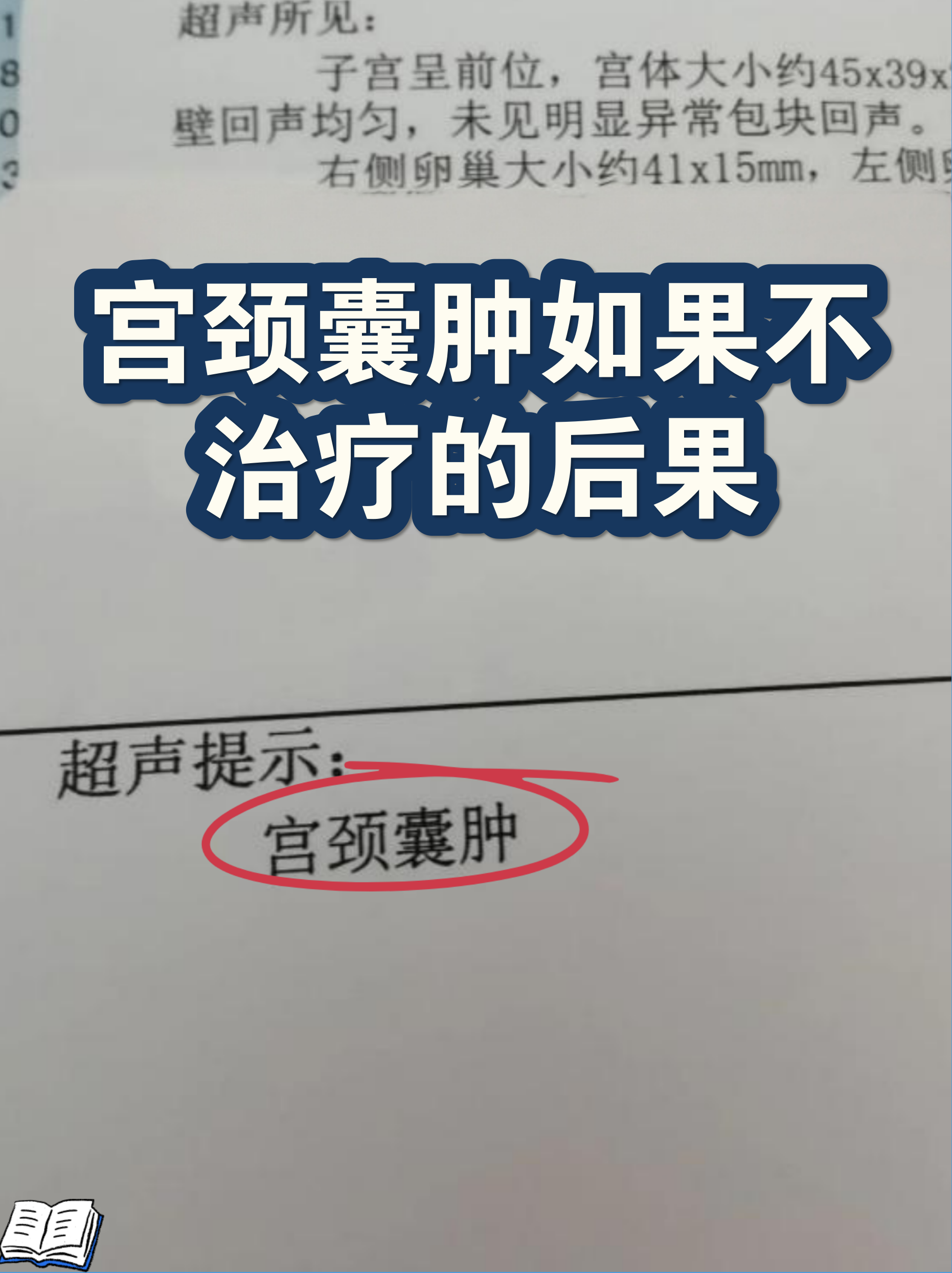 宫颈囊肿图片大全(宫颈囊肿图片是什么样 清晰图片) 宫颈囊肿图片大全(宫颈囊肿图片是什么样 清晰图片)