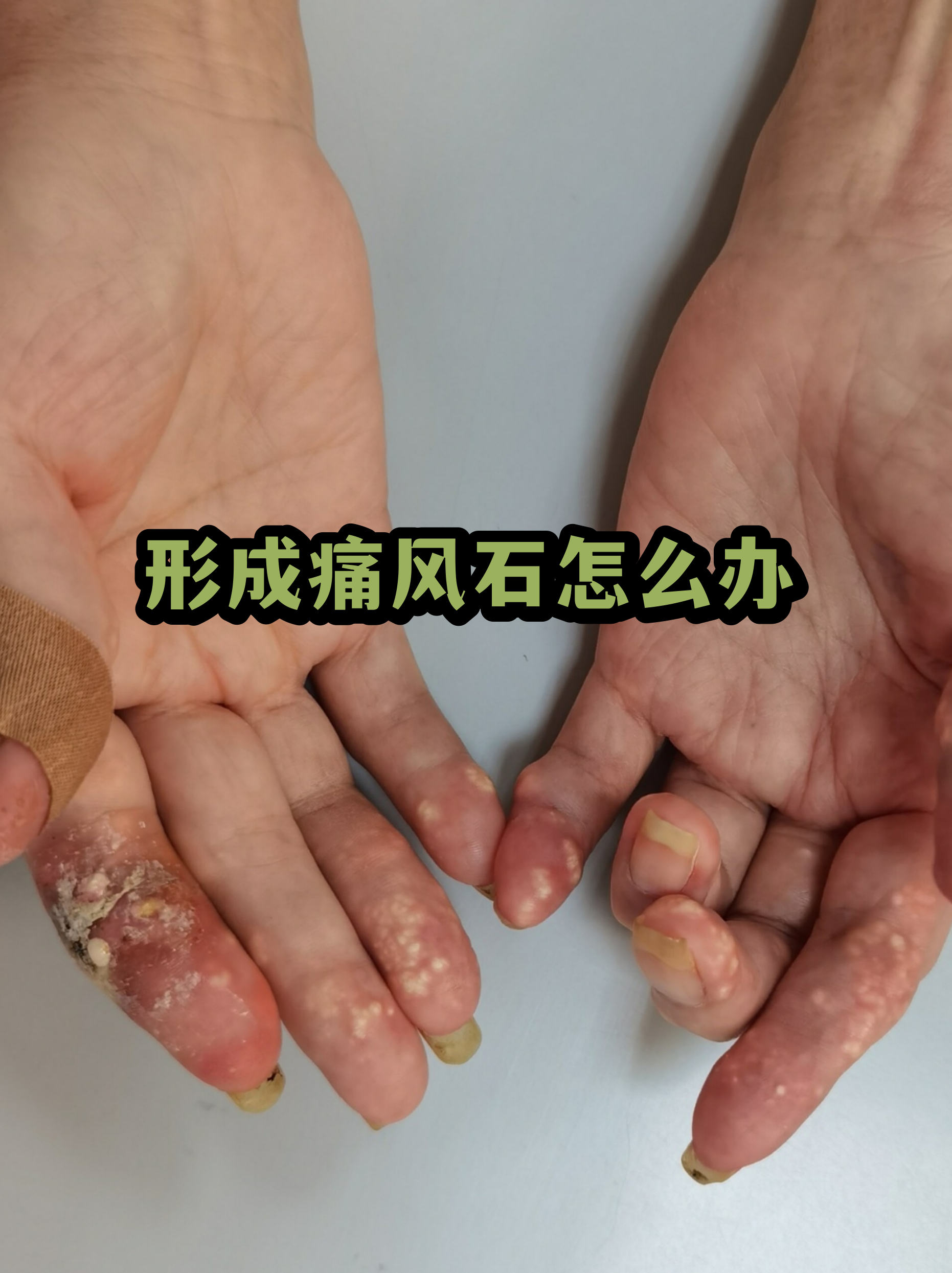 痛风石初期的样子(痛风石初期的样子图) 痛风石初期的样子(痛风石初期的样子图)