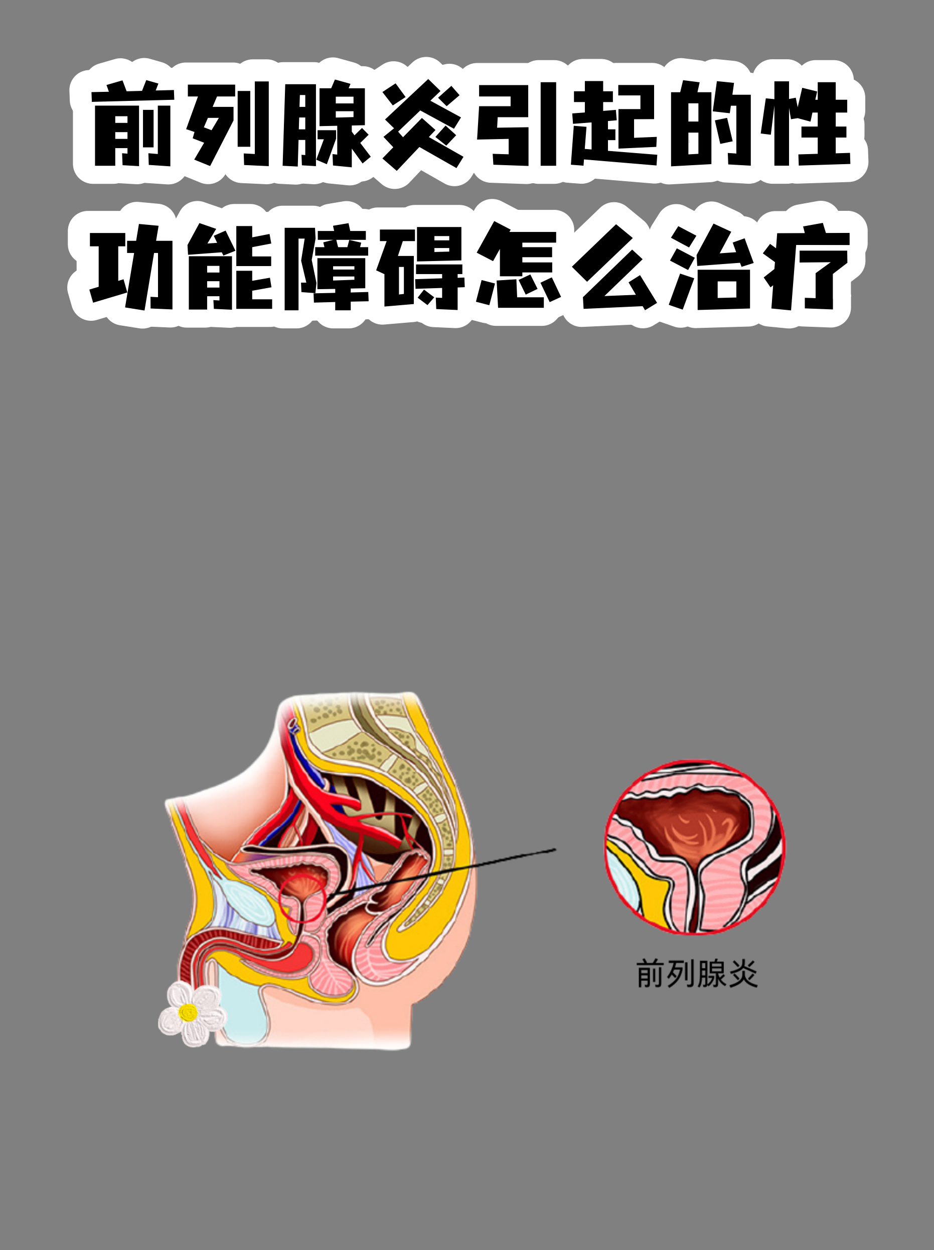 前列腺炎症状图片(前列腺炎症状能自愈吗)
