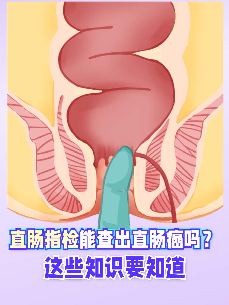 直肠癌肛门图片(直肠的位置清晰图)